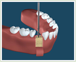インプラント手術：1