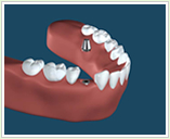 インプラント手術：5