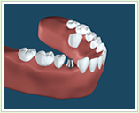 インプラント手術：6