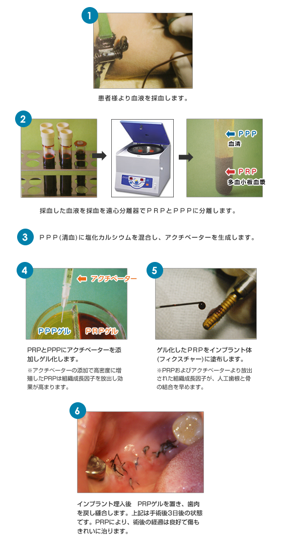インプラント埋入時のPRP手順