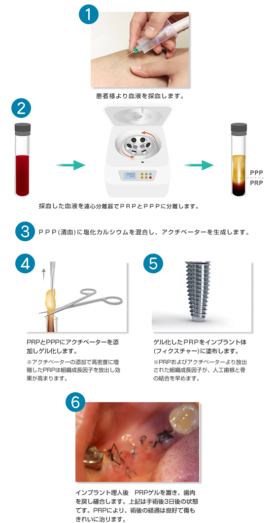インプラント埋入時のPRP手順