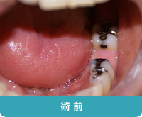 術前