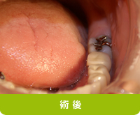 術後