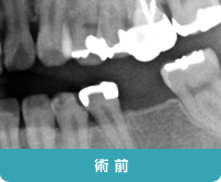 術前