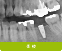 術後