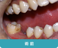 術前